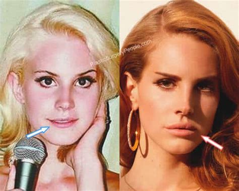 lana del rey lip filler.